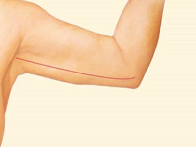 جراحی زيبايی و ليفت بازو چيست؟