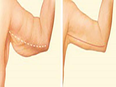 مراحل جراحی زيبايی ليفت بازو