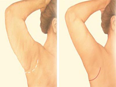 مراحل جراحی زيبايی ليفت بازو