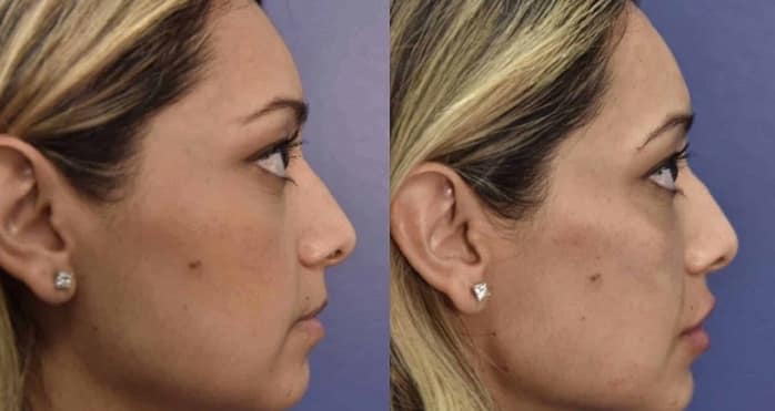 در طی زاویه سازی صورت با تزریق ژل، انتظار چه چیزی را باید داشته باشیم