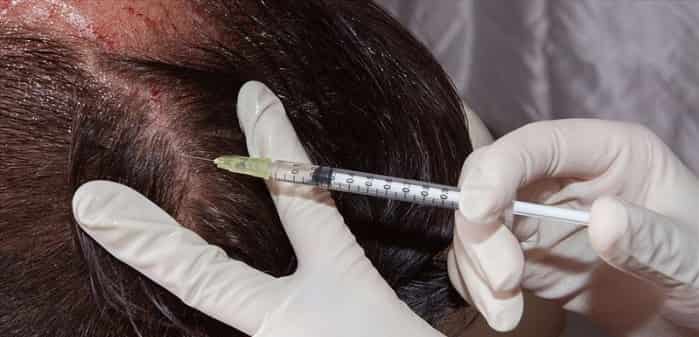 درمان ریزش موی سکه‌ای با کورتیکواستروئیدها